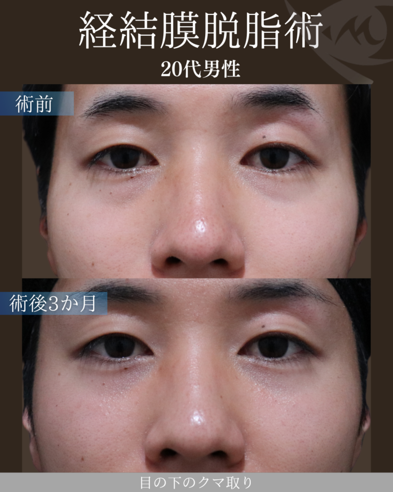20代男性 経結膜脱脂術 術後3ヶ月